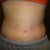 2 weeks PO.  My stretch marks look very transparent and I am very happy about that!