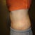 2 weeks PO side view