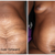 Post Partum Belly