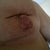 right breast 2 days post explant - this was the worst of the sides affected by the capsular contracture