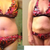 Before and PO day 8 comparison in bikini