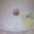 Incision area Day 17 PO