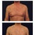 Doctors Say Don't Waste Your Money on Gynexin for Man Boobs