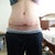 21 days post op (3 weeks). You can see the spot with the skin necrosis, but it's getting better.