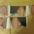 How quickly we can forget where we were only a month ago. Dr. Eisenberg gives you these "before" snaps that he takes right before you get wheeled in to surgery... I almost couldn't believe it when I looked at them.