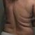 Back view post 2 days