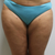 Front thighs 2 months