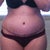 2 weeks PO - scar