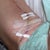 The butterfly strips mark the edges of the blowout, which was on the curve of incision. Blowout Sat 8/27 and photo is Mon 8/29