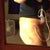 6 Day PO Bruising