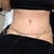 6 Day Check Up    Pain Pump Removal
