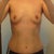 2 weeks after surgery