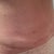 Dog ear on right side. kinda hard to tell but its like a pocket of fat! gross