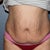 one day before surgery front view