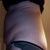 Tummy Left View PreOp.