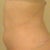 sharpie lines, side view morning after procedure