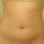 1 month after procedure