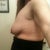 before surgery- floppiness