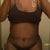 Front View 2 week post op