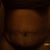 Front View 2 week post op