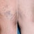 5 Amazing Vein Treatment Before and Afters