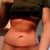 12 days post op- sterri strips off!
