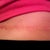 4 weeks po, scar