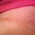 4 weeks po, scar