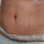 7 Days Post Op