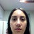 After-7 weeks, look at the left side of the pic how my nose appears as if its curving