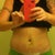 one week post op