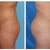 Before on the right- After on the left... Pictures taken at Dr.Ghavami's office. And he wants me to be thankful for this??? Pffft!! He is a joke!