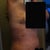 Right side - 3 days after.  Its hard to take post op pictures of yourself in a mirror when you can barely move. LOL