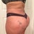 21 days post op