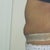 5 weeks post tt