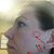 Disappointed, as I was initially pleased with the results of the fraxel treatments. My skin looked better a month ago than it does now :(.  This photo shows the pigmentation differences that have begun to appear in my skin.