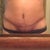 4 Weeks Post Op.  Do not like how dark my incision looks, but still no regrets as it is much better than before.  Hoping it will still lighten some more.