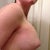 Day 6....but here is a side view. Upper pole fullness.