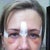 Day 6 (see one eye has Chemosis )