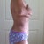 5 weeks post op side