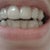 Tray#3 - aligners in