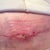 "Spitting sutures".  Dr said its fine, keep clean an dry, and it's ok when pulling off gauze it rips. It's removing the dead cells :). (Sideways!)