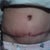 I had to laugh when I noticed it is a heart shape Belly Button.. 21 days post op