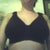 11 days post op