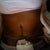 1 week--post-op