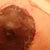 nipple wound bleeding