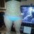 15 days post op, big ass thighs I know.. and my tummy is lumpy =/ but flat!
