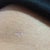 Lipo incision. It's tiny (smaller than a pencil eraser)