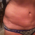 Scar at 6 weeks post op ... Swelling in flanks
