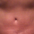 Scar at 6 weeks post op